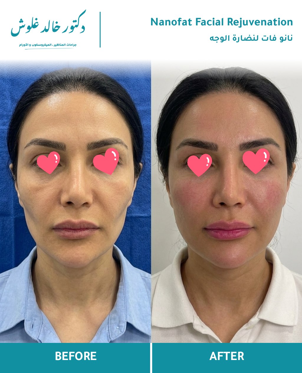 نانو فات لنضارة الوجه