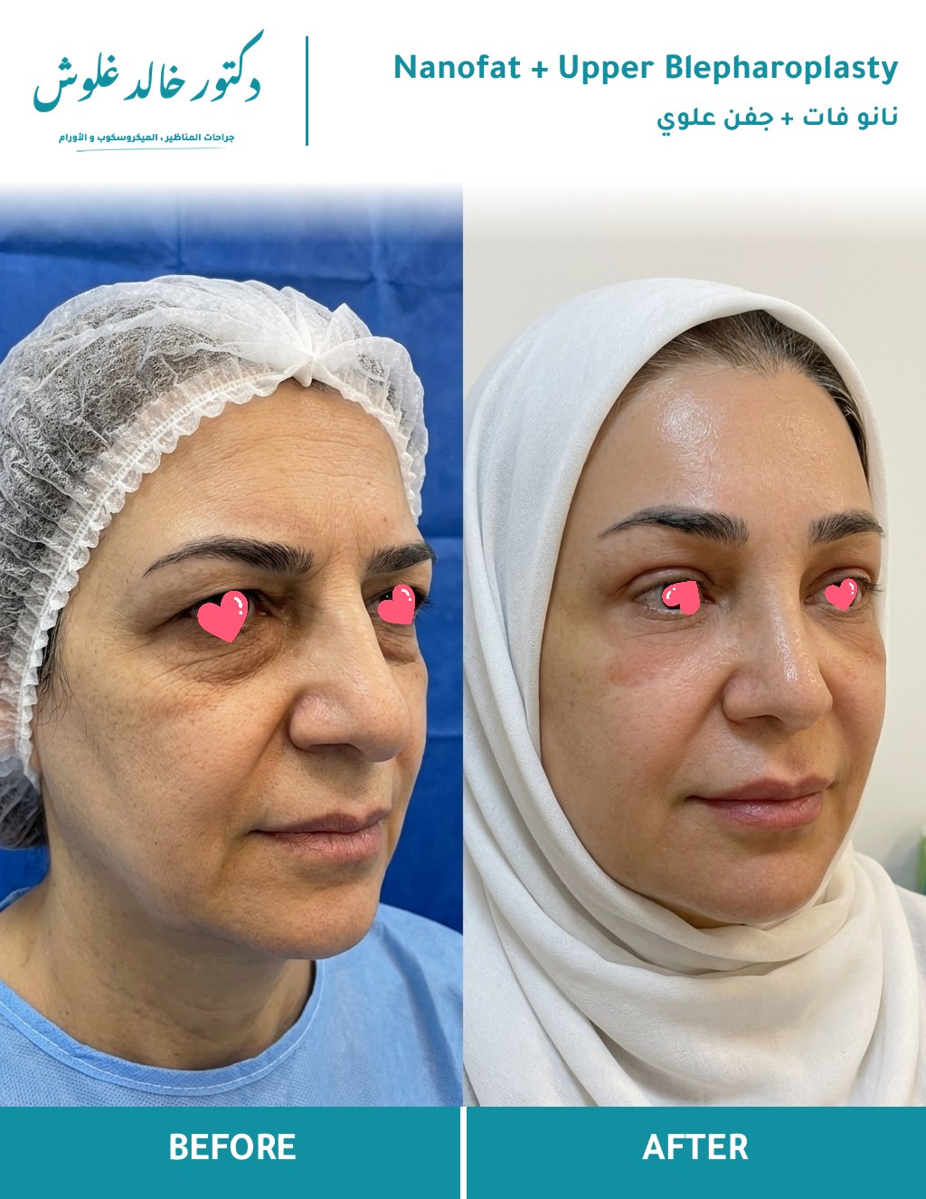 نانو فات + جراحة الجفن العلوي