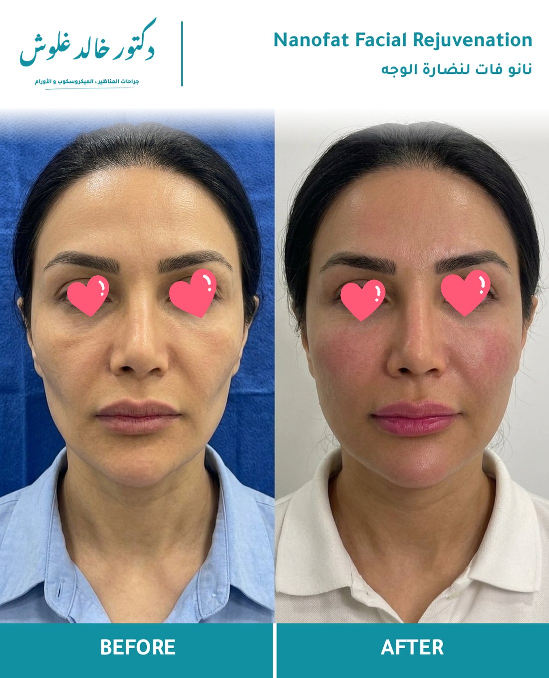 Nanofat — Regenerative Facial Rejuvenation
