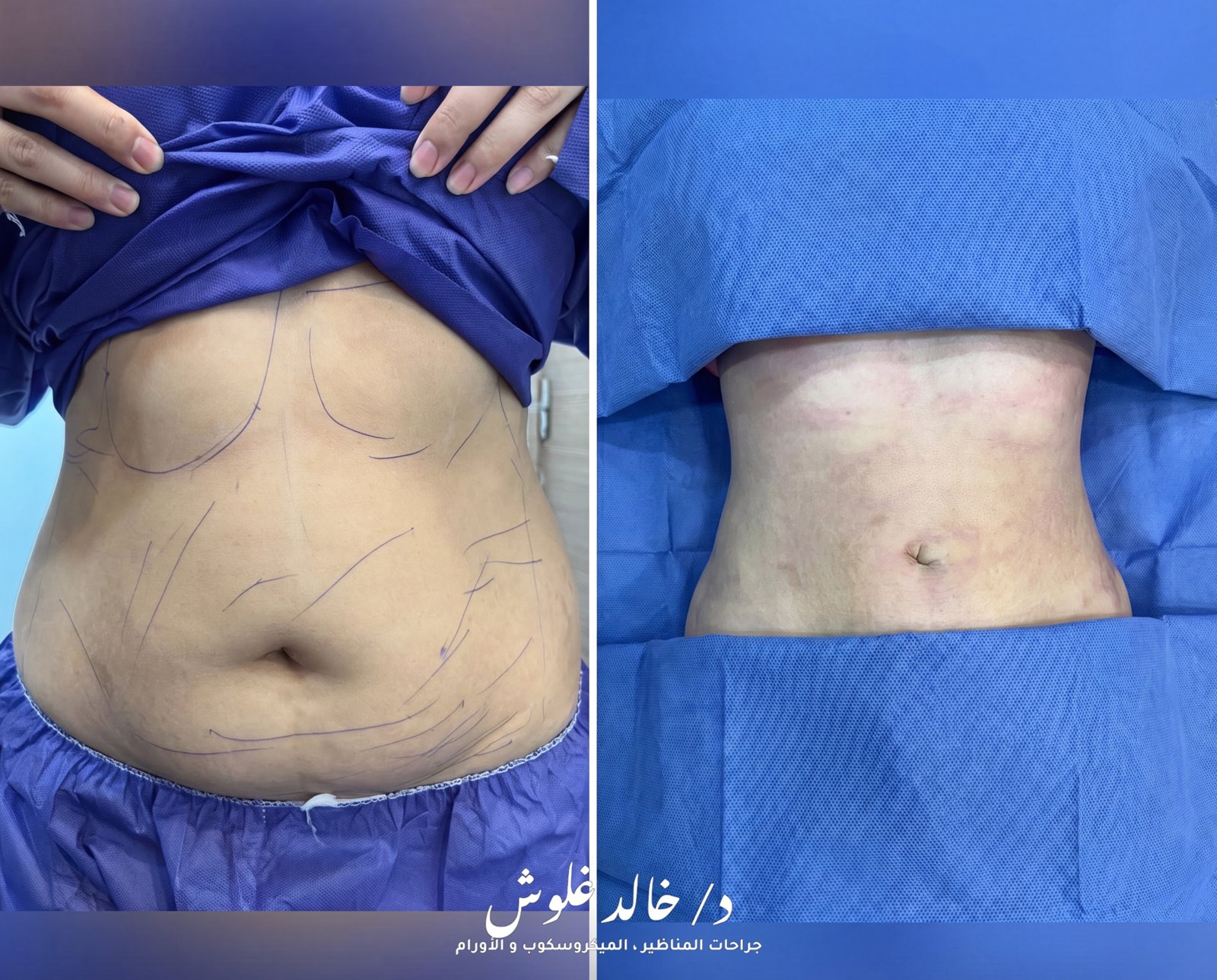 Body Contouring