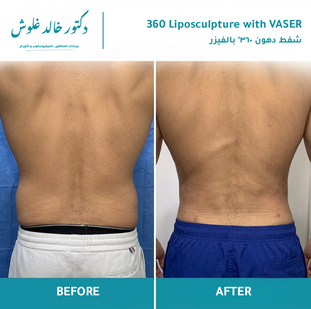 360° VASER Liposculpture — patient result