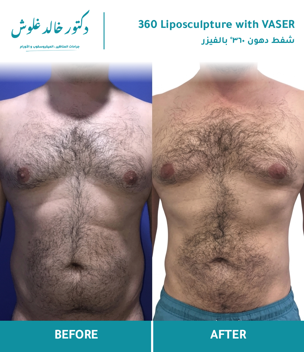 360° VASER Liposculpture — patient result