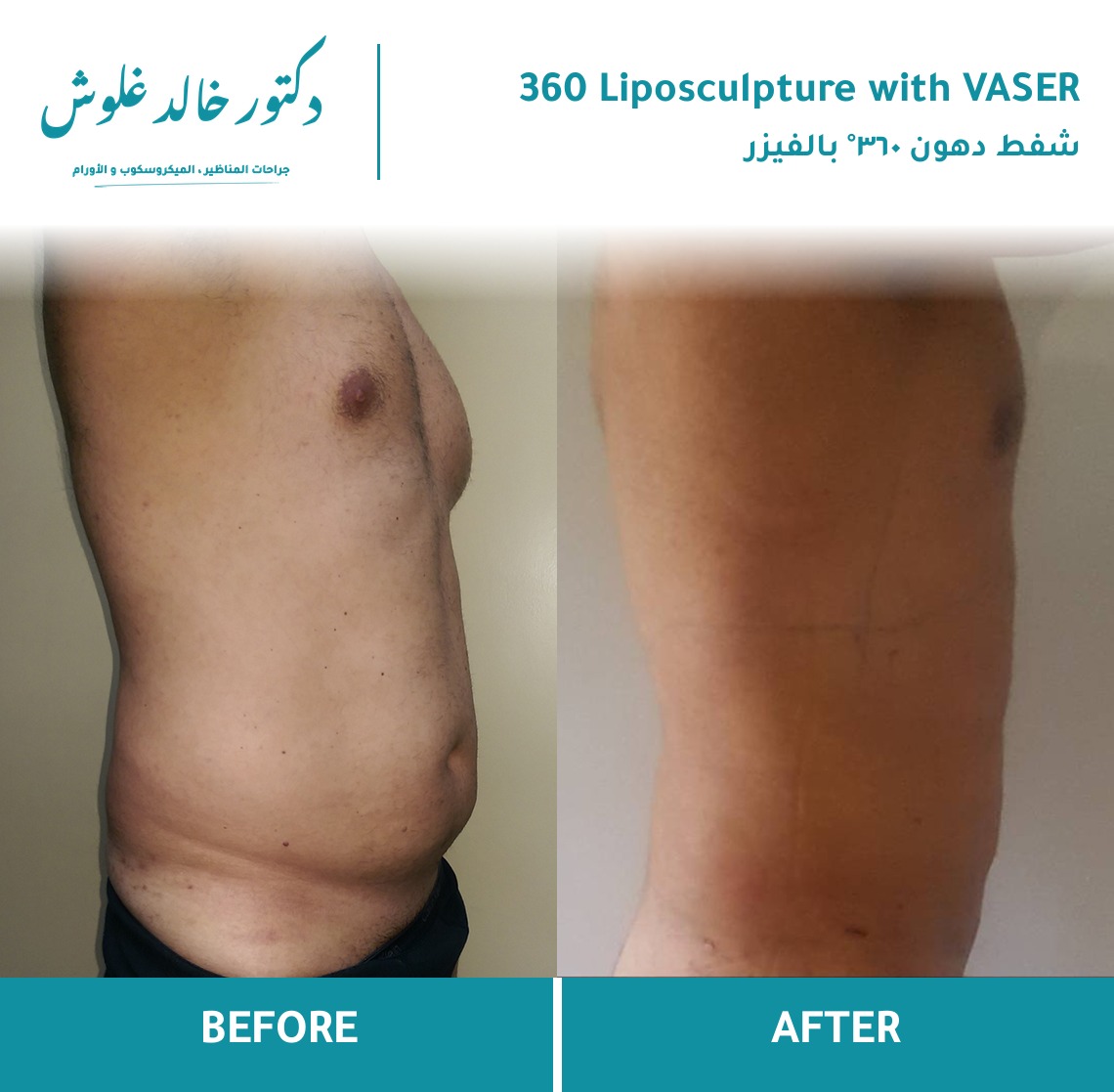 360° VASER Liposculpture — patient result
