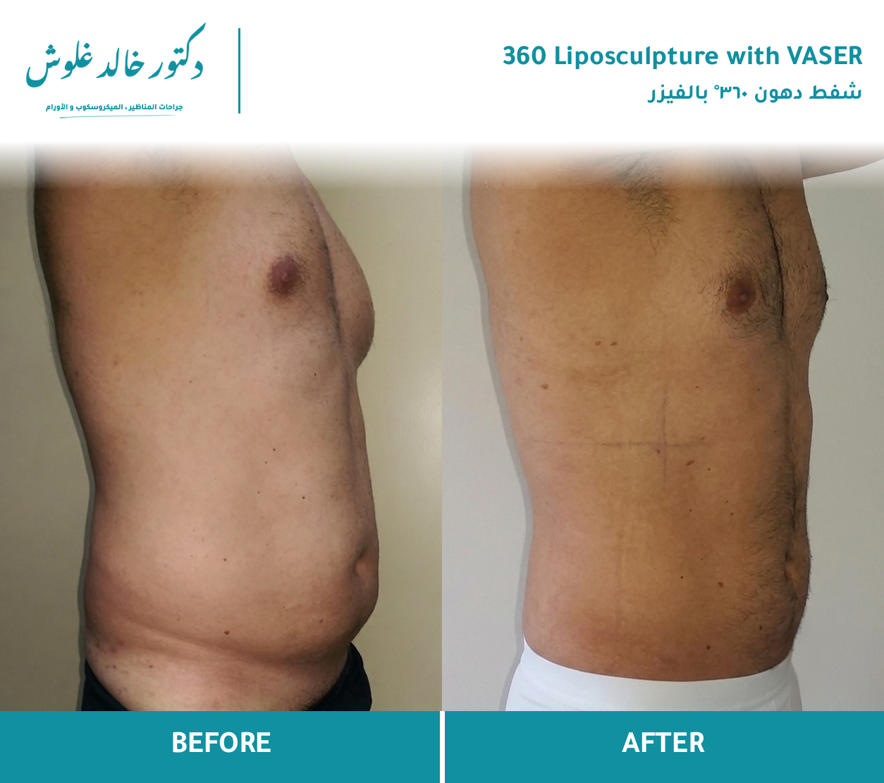 360° VASER Liposculpture — Male, Chest & Torso
