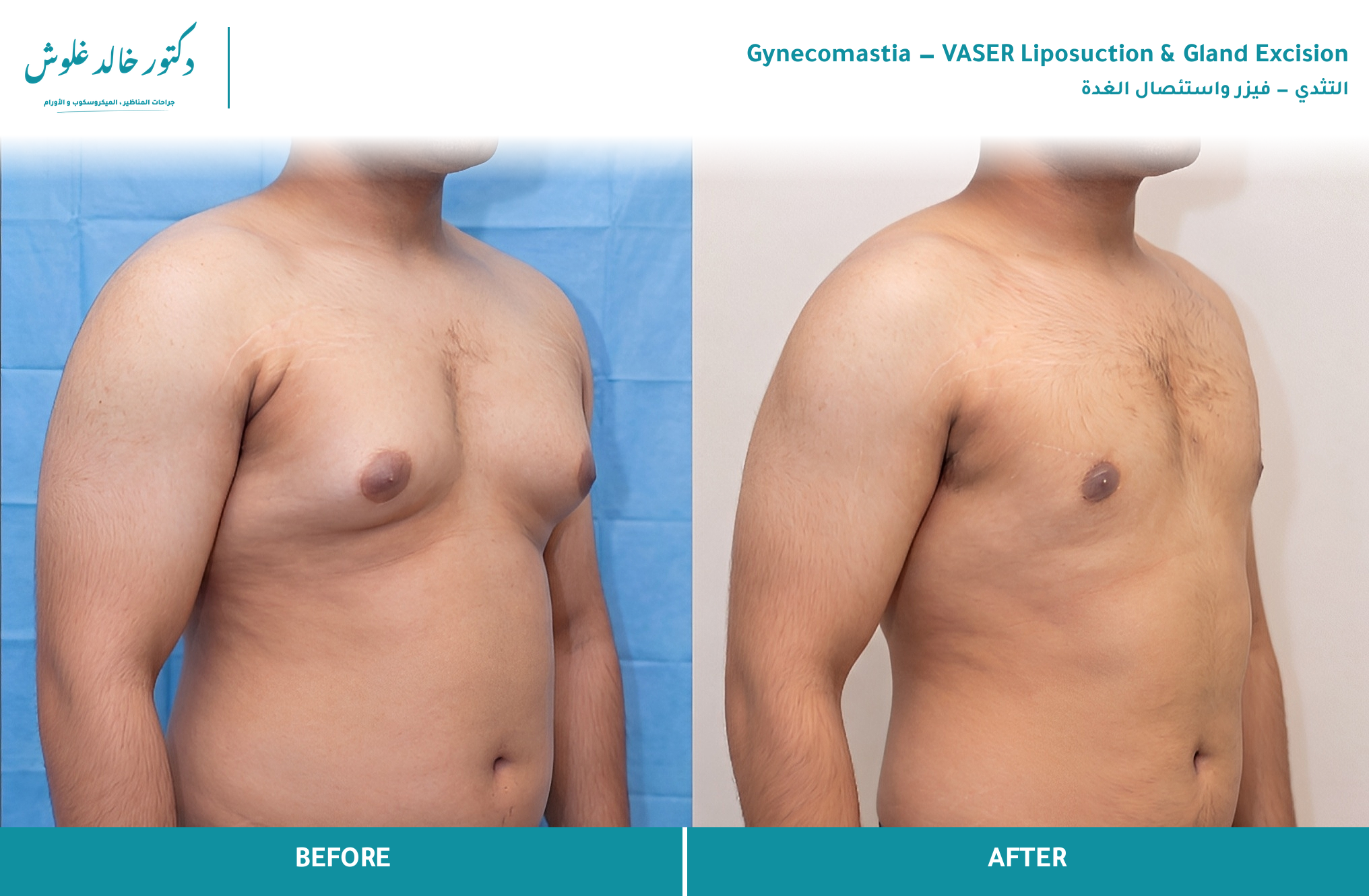 Gynecomastia — Male Chest Correction