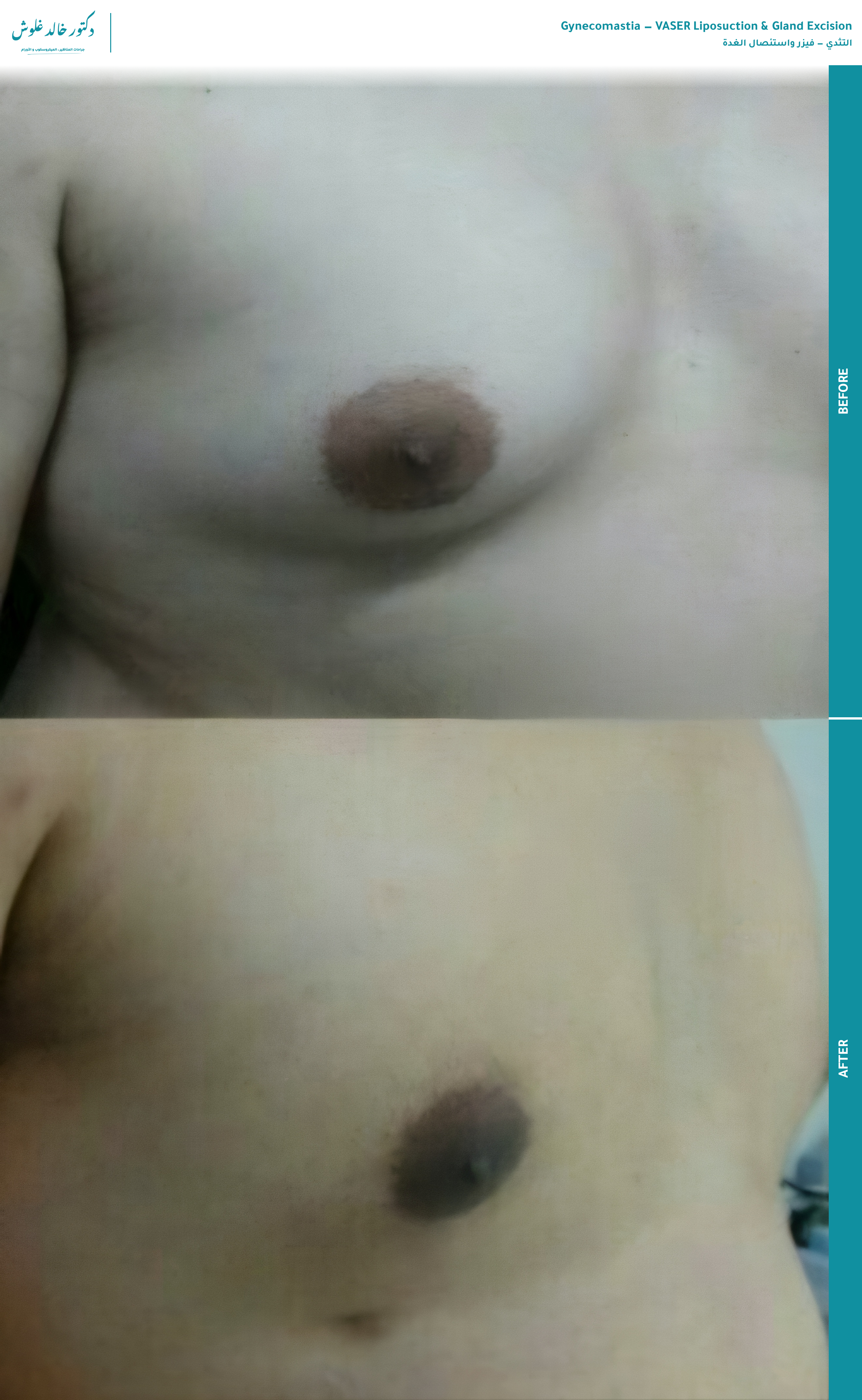 Gynecomastia — VASER & Gland Excision (front view) — before and after
