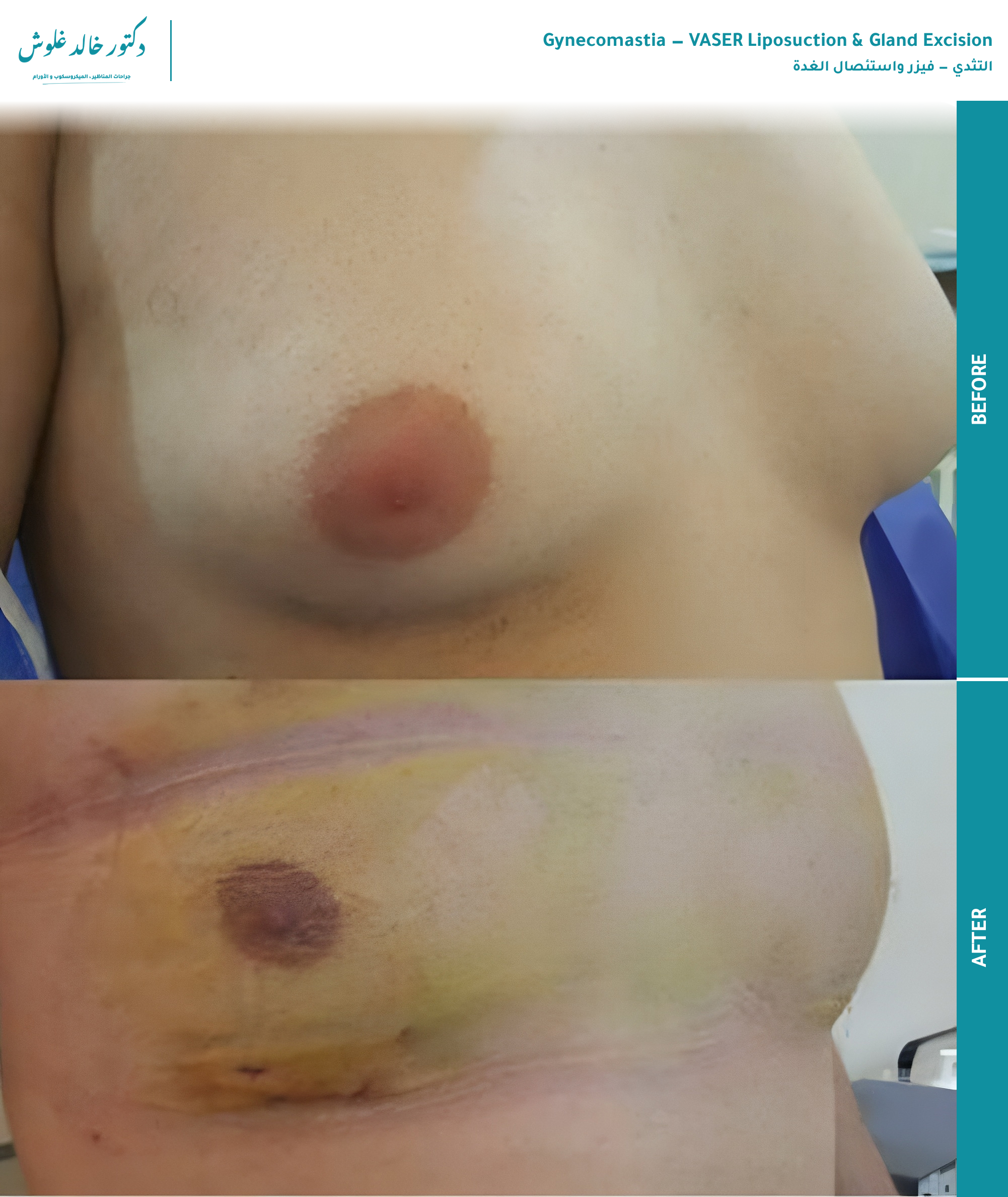 Gynecomastia — early post-operative result — before and after
