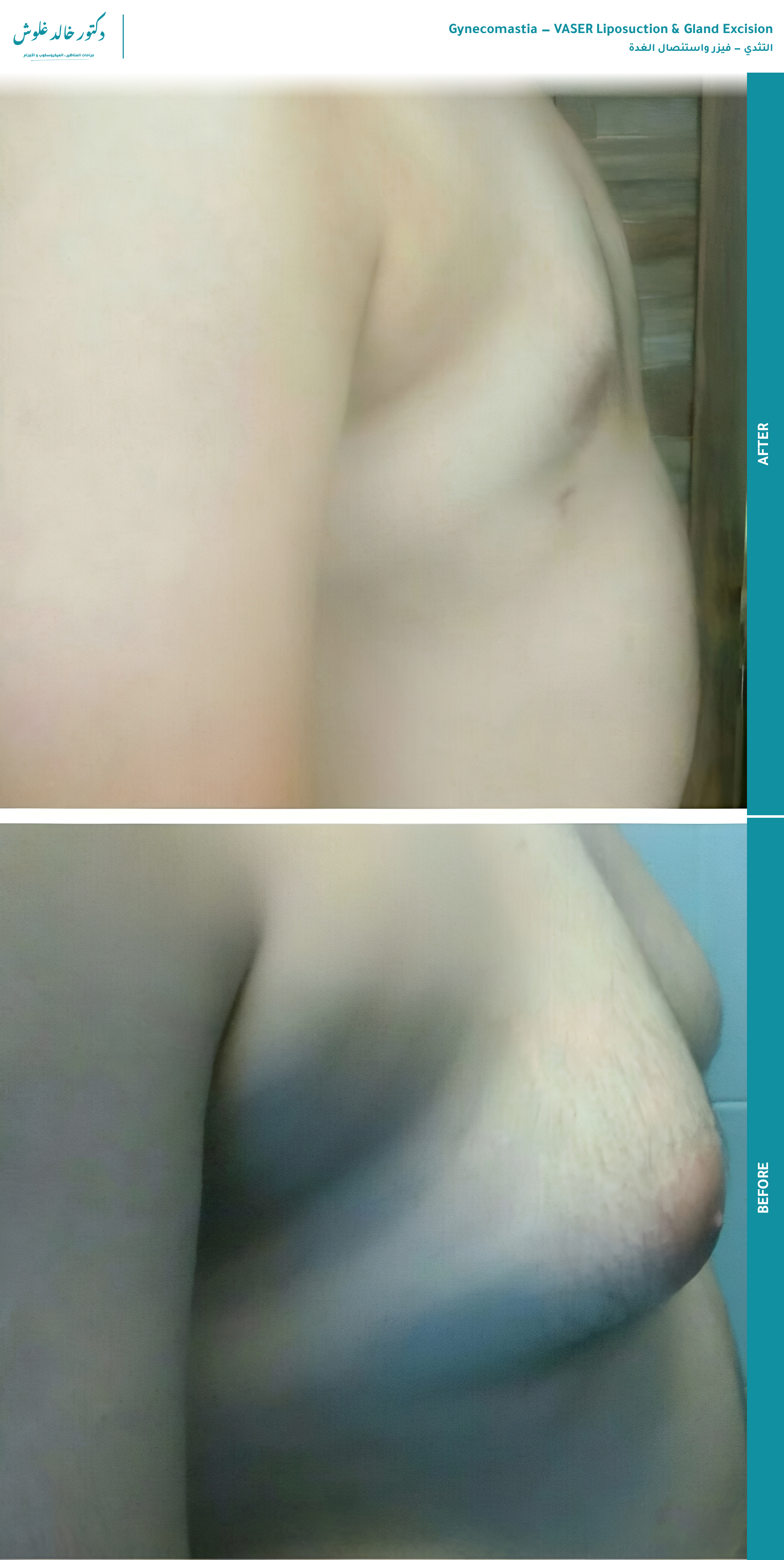 Gynecomastia — VASER & Gland Excision (side view) — before and after