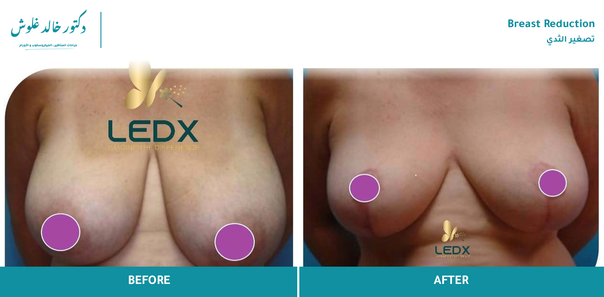 Breast Reduction — Case 1 (front view)