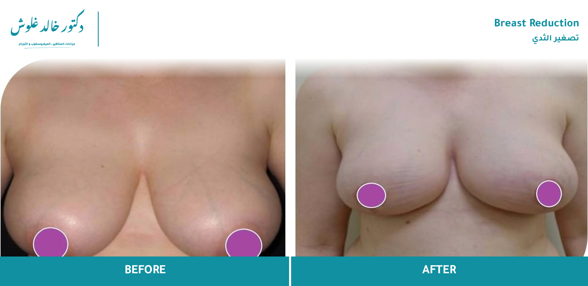 Breast Reduction — Case 2 (front view)