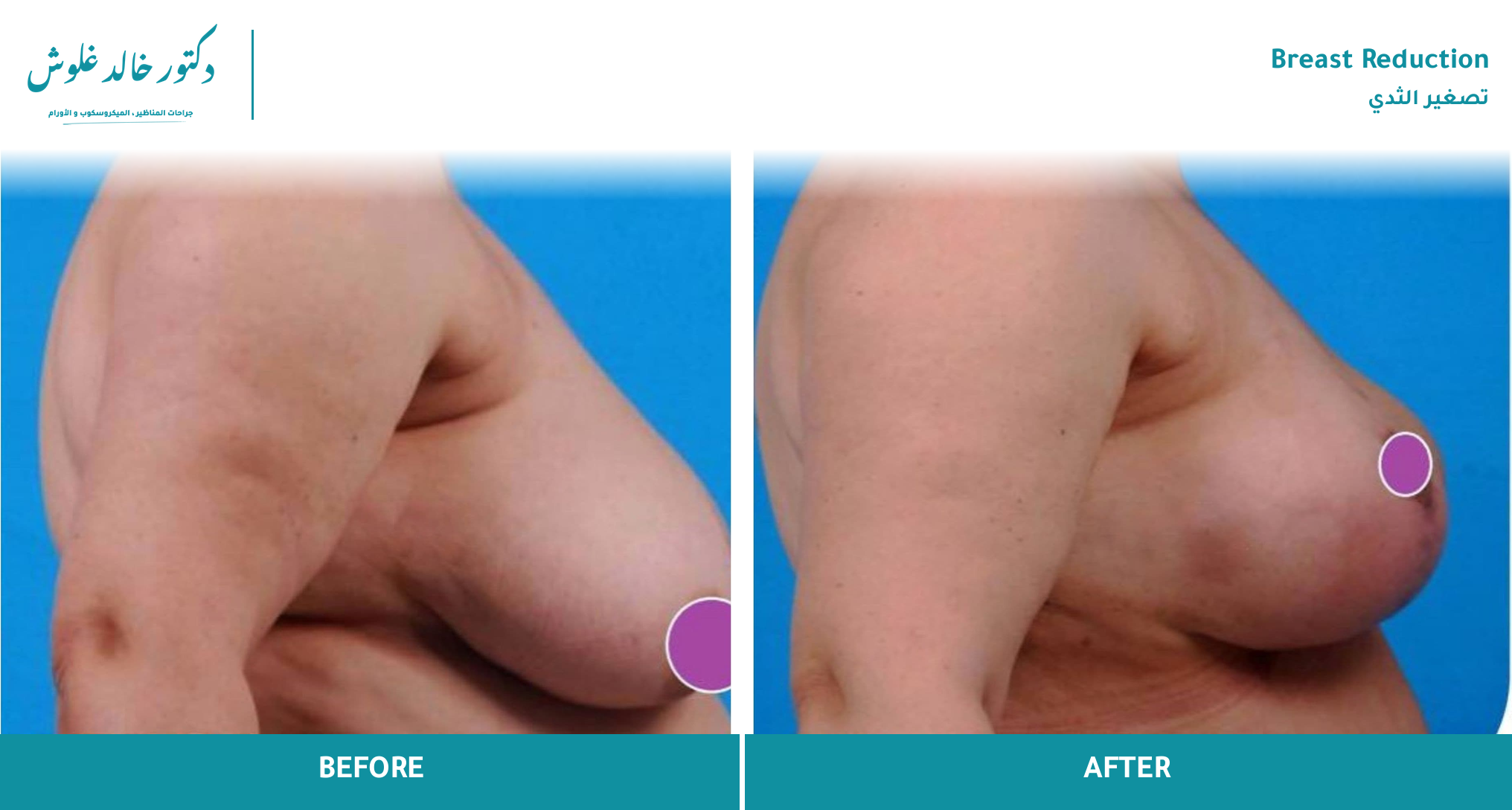 Breast Reduction — Case 3 (side view, early post-op)