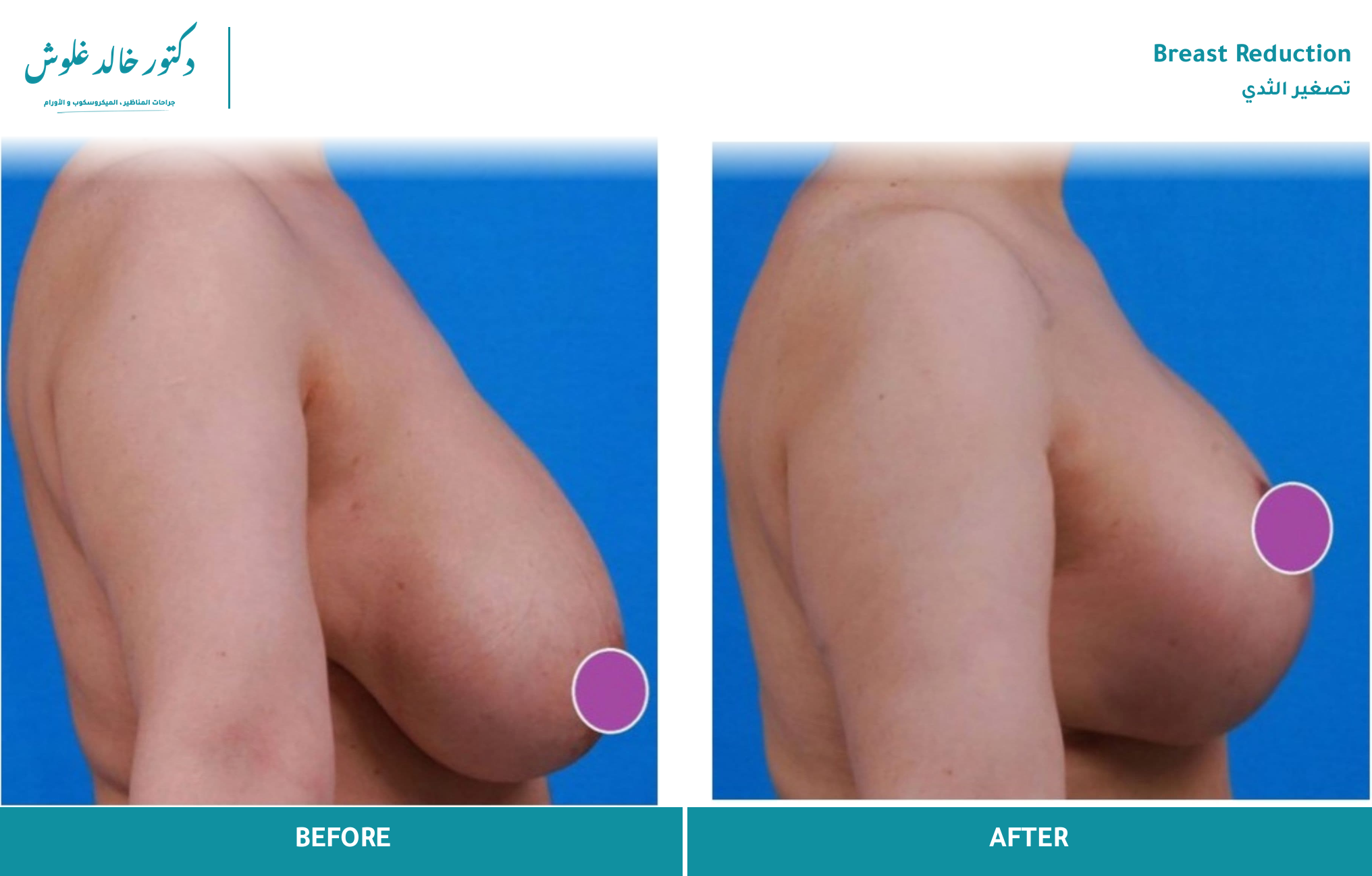 Breast Reduction — Case 4 (side view)
