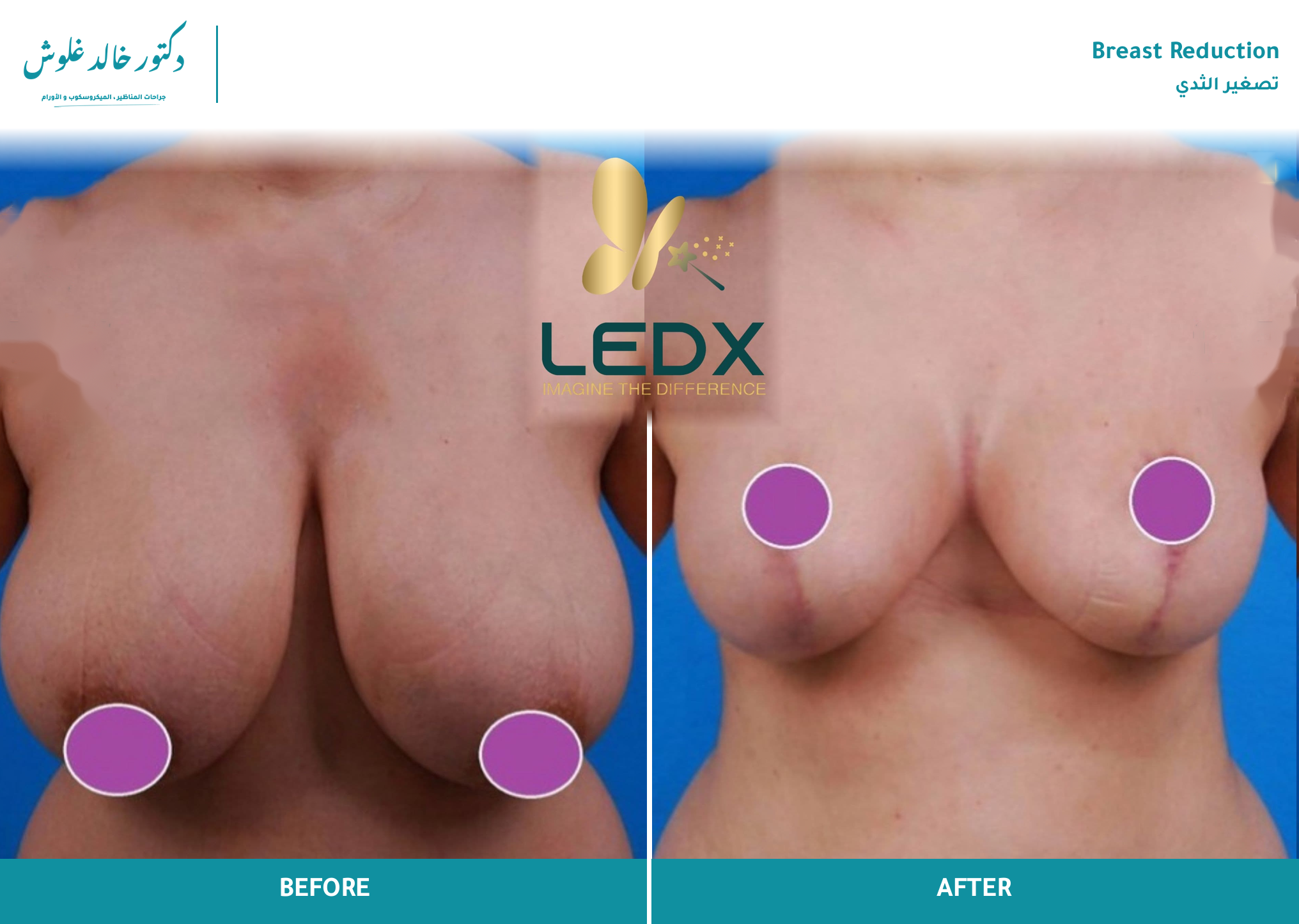 Breast Reduction — Case 5 (front view)