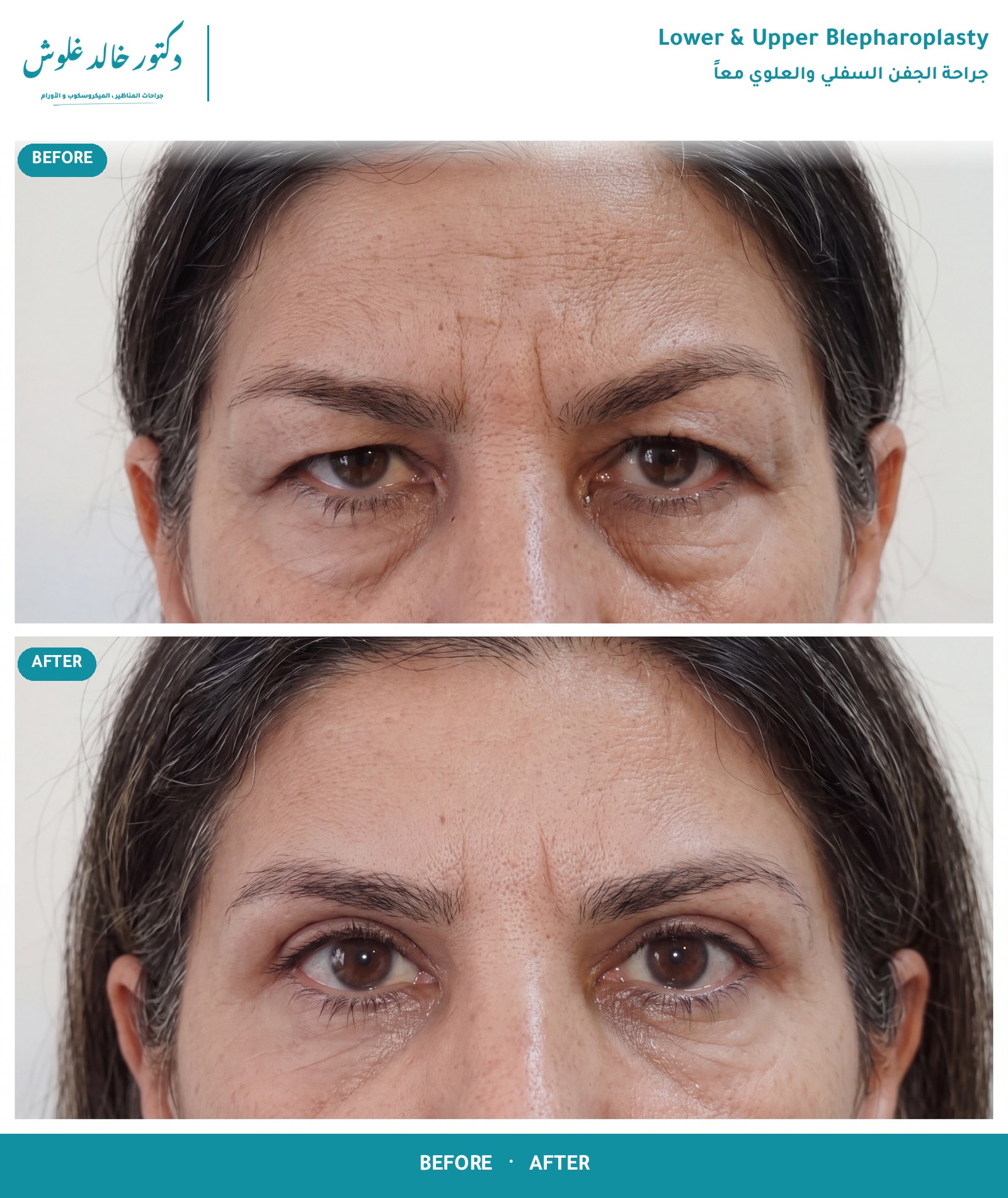 Lower & Upper Blepharoplasty — Heavy upper lids and under-eye bags — both lids in one session