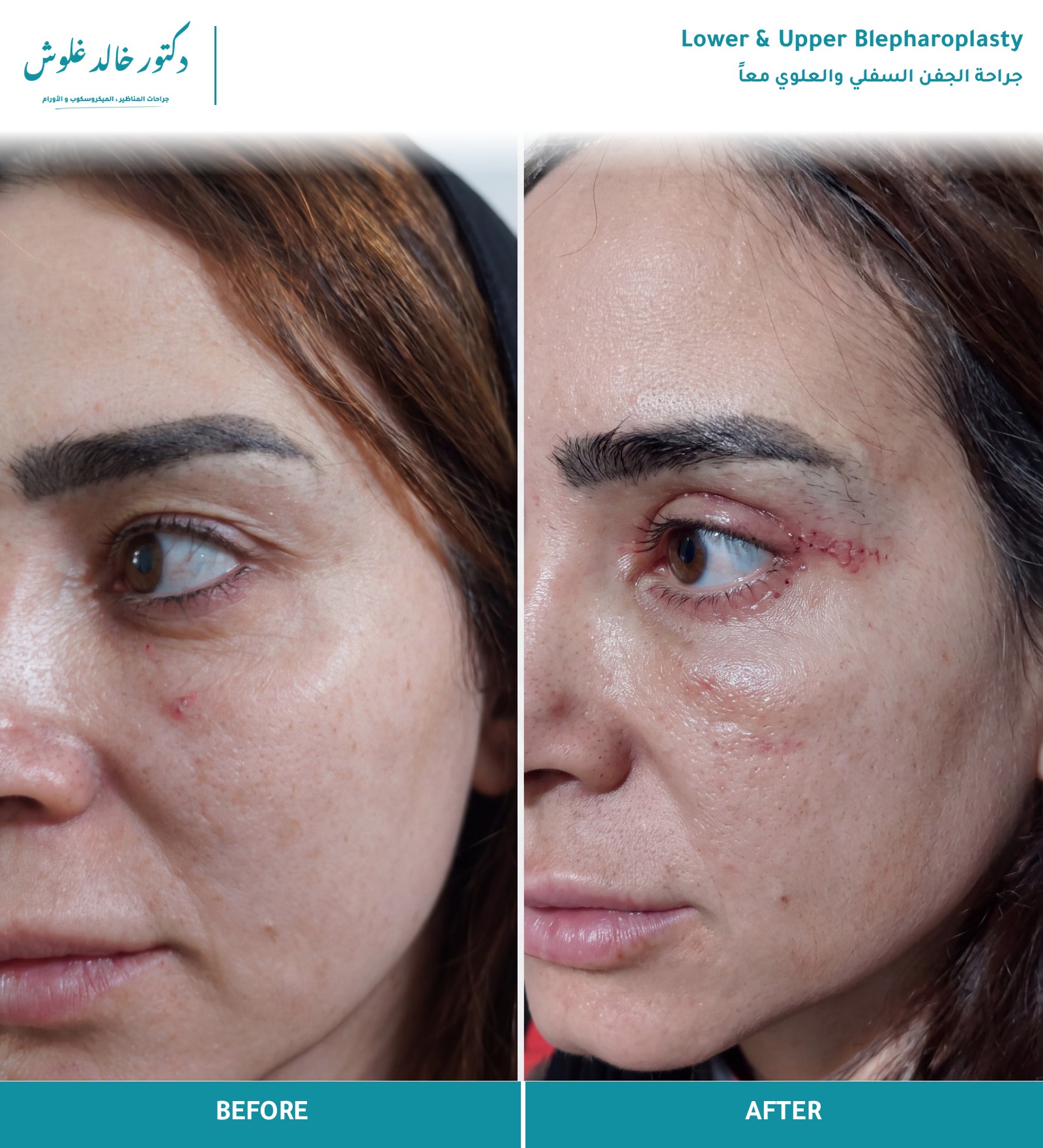 Lower & Upper Blepharoplasty — Early recovery view — upper and lower lid incisions with fine sutures - 1
