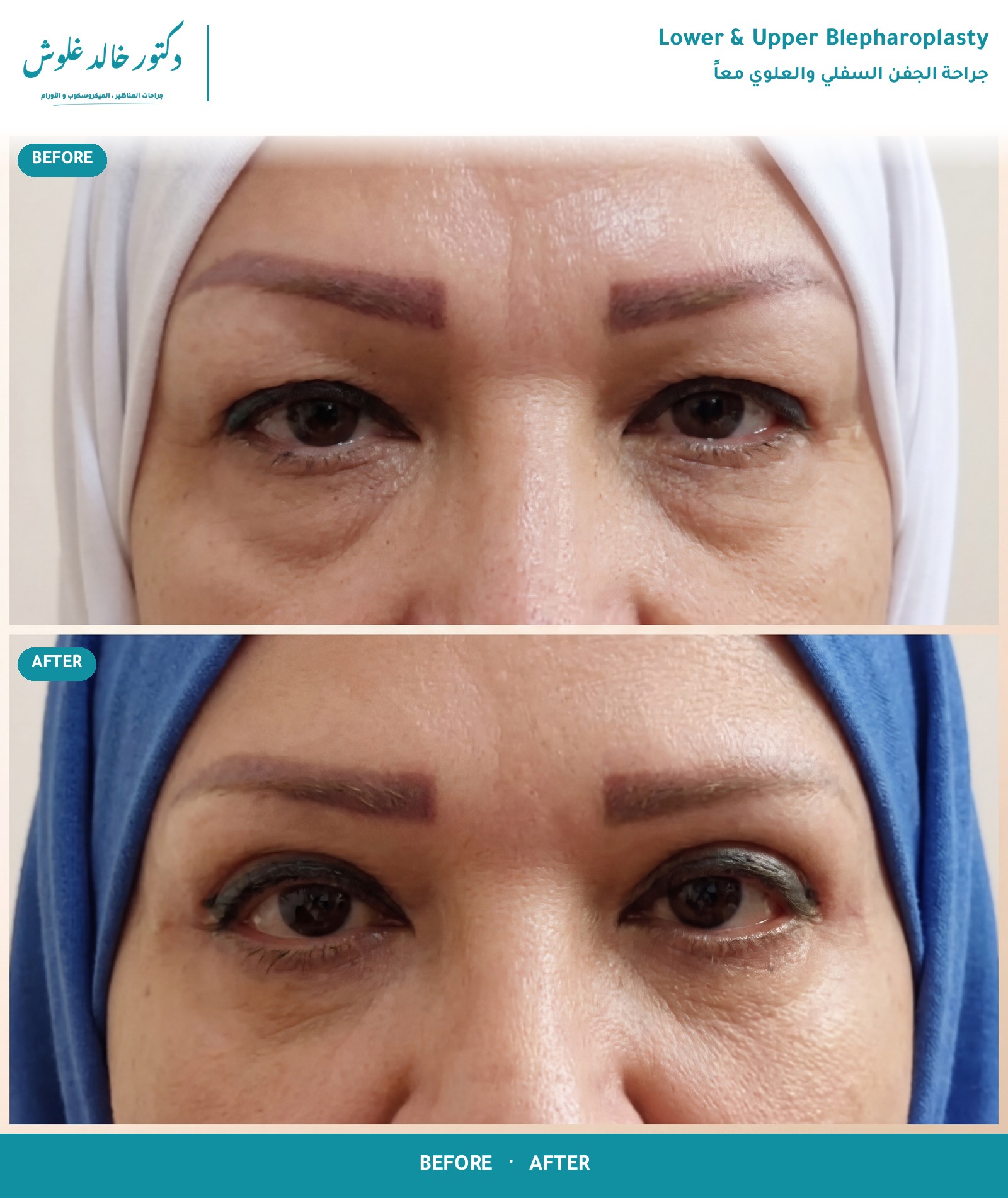 Lower & Upper Blepharoplasty — Under-eye bags and heavy upper lids — combined blepharoplasty