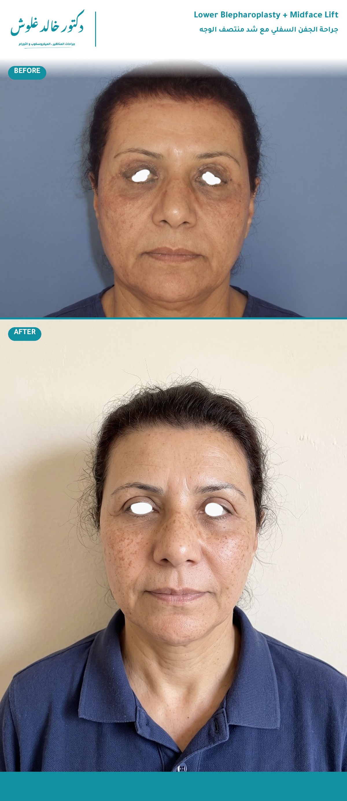 Lower Blepharoplasty + Midface Lift — Severe Under-Eye Hollowing - 1