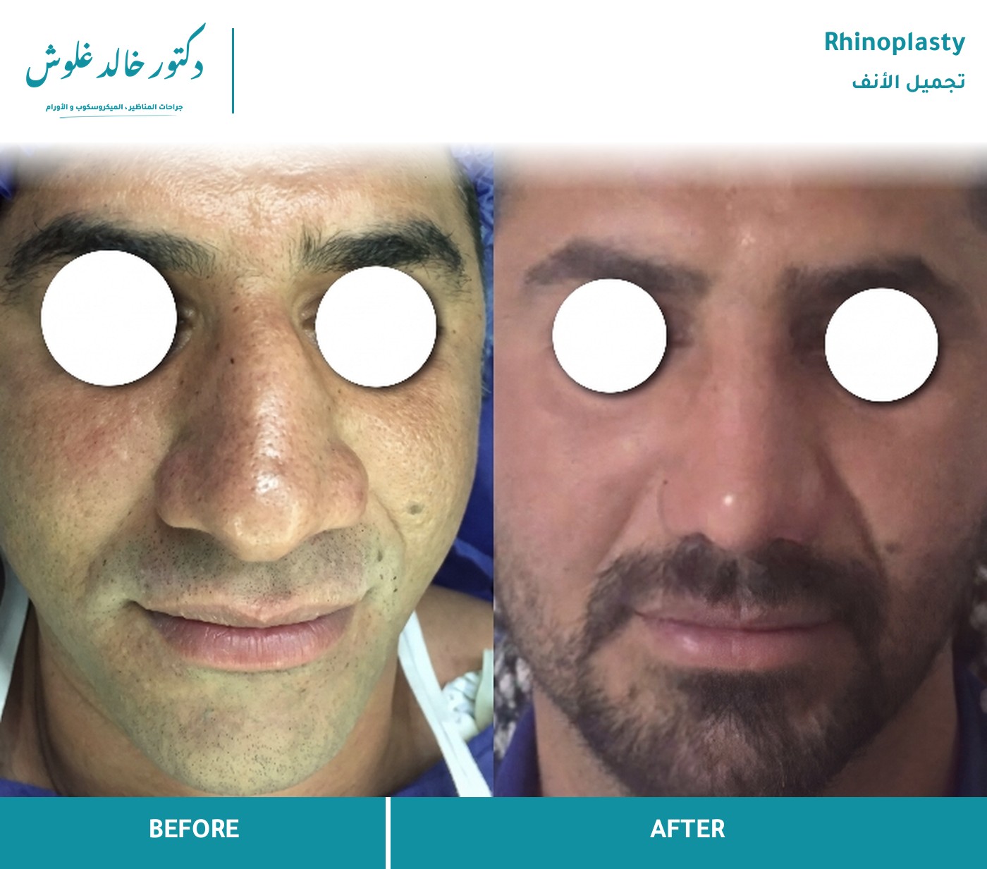 تصغير حدبة الأنف وتحسين طرف الأنف