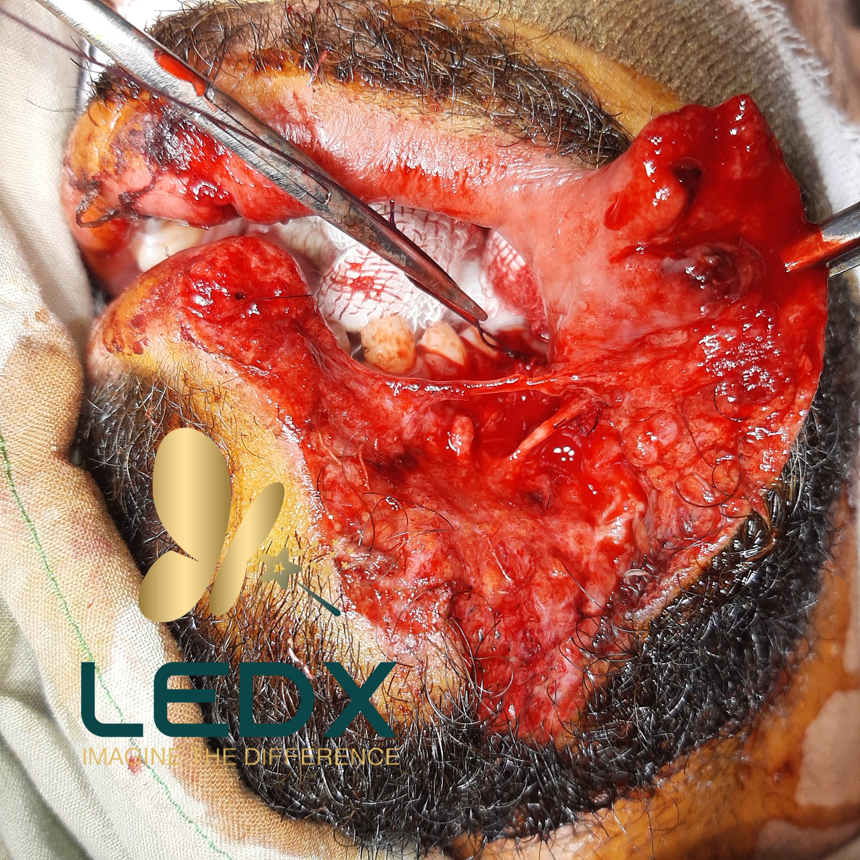 Jaw & Lower-Face Wound Reconstruction - Image 2