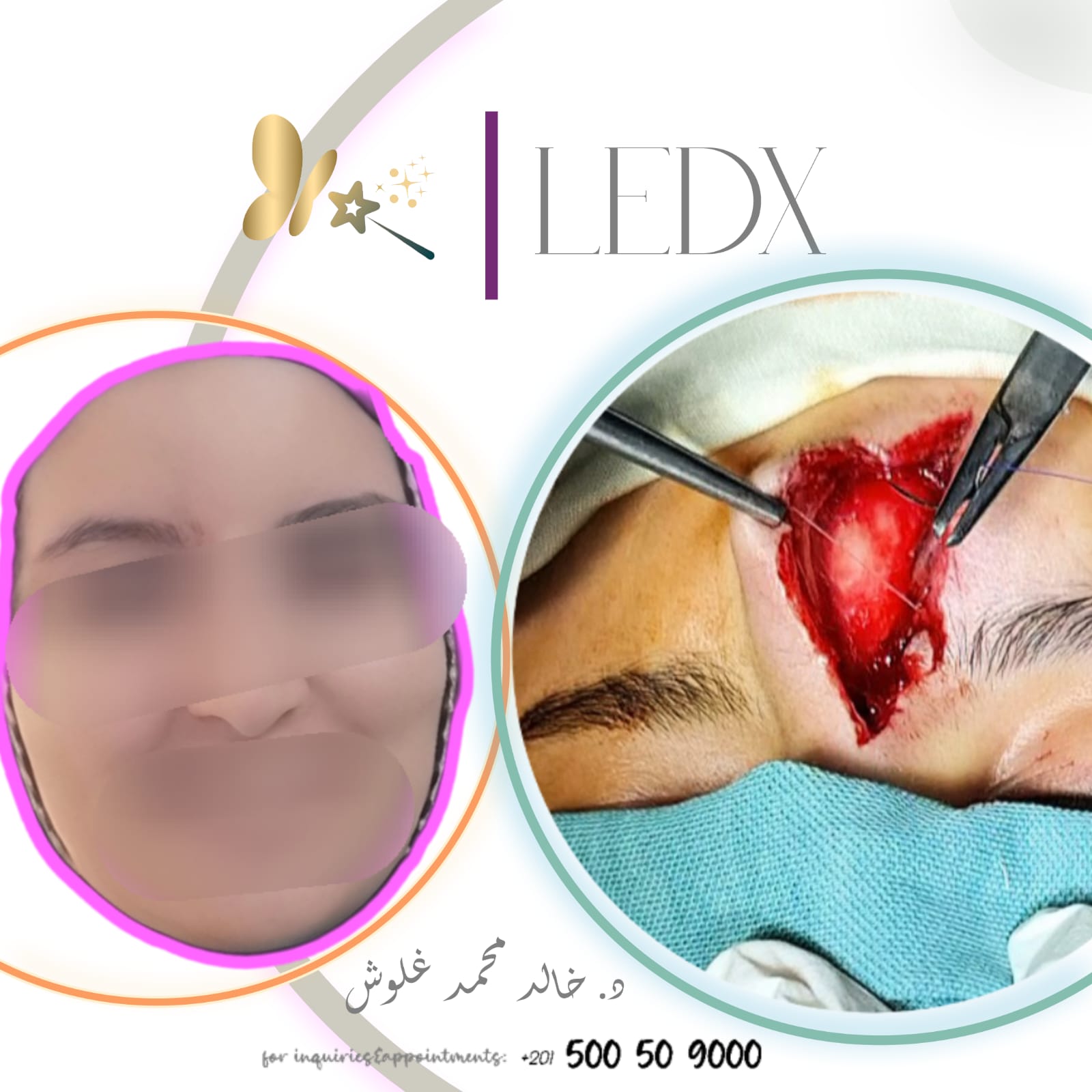 Forehead & Eyebrow Reconstruction — Case 1