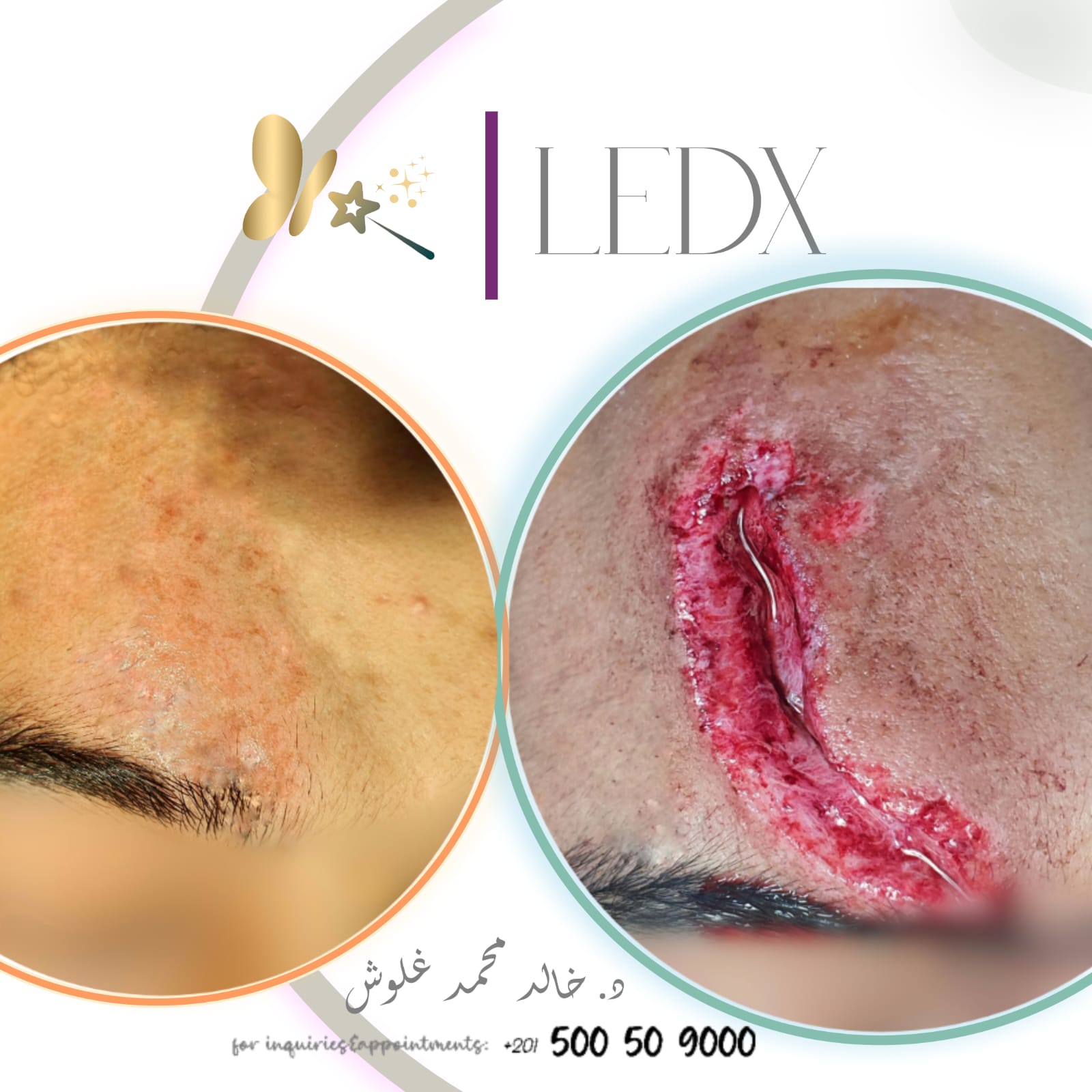 Forehead & Eyebrow Reconstruction — Case 2