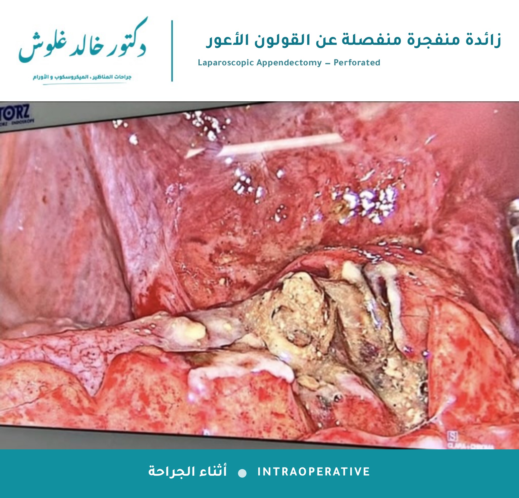 زائدة منفجرة منفصلة عن القولون الأعور