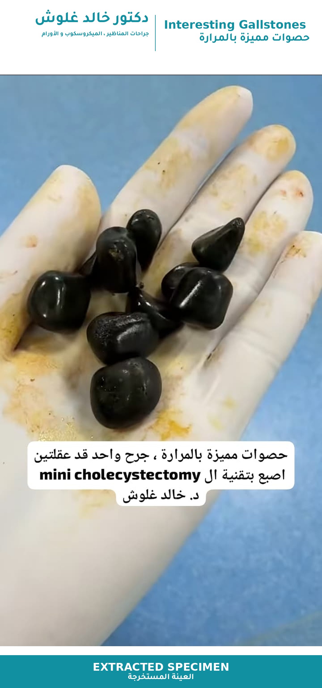 Interesting Gallstones - 1