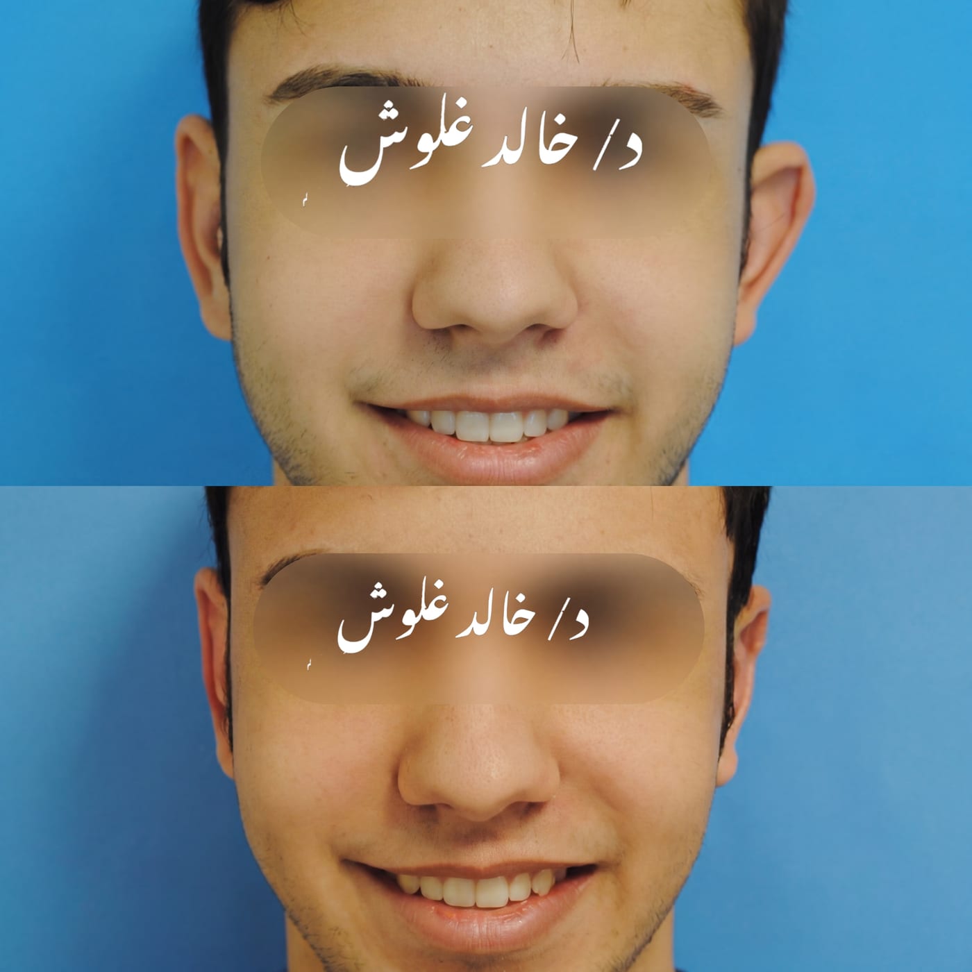 تصحيح بروز الأذن — حالة بالغ