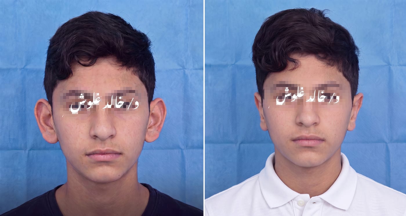 تصحيح بروز الأذن — مراهق